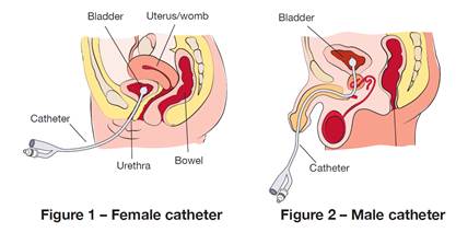 indwelling catheter