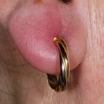 Dealing with Infected Ear Piercing Causes, Symptoms, and Effective Treatments infected ear piercing