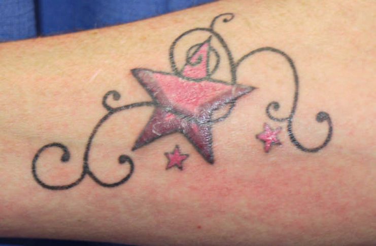 infected tattoo