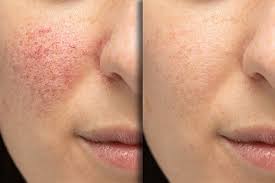 ipl photofacial