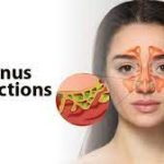 Is Sinus Infection Contagious? Debunking the Myths and Facts is sinus infection contagious