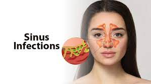 is sinus infection contagious