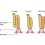 Navigating Life with a J-Pouch Your Comprehensive Guide j pouch