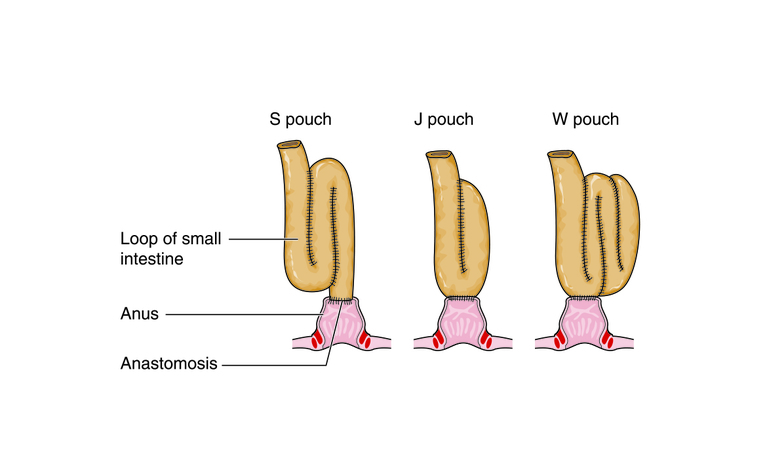 j pouch