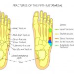 Jones Fracture Causes, Symptoms, and Treatment jones fracture