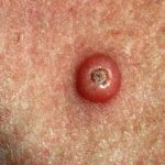 Keratoacanthoma Causes, Symptoms, and Treatment keratoacanthoma