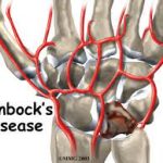 Decoding Kienbock’s Disease: Symptoms, Causes, and Treatment Explained kienbock's disease