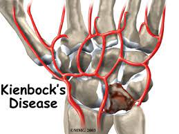 kienbock's disease