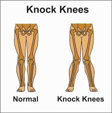 Demystifying Knocked Knees: Causes, Treatment, and Exercises