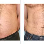 Transform Your Body with Laser Liposuction laser liposuction