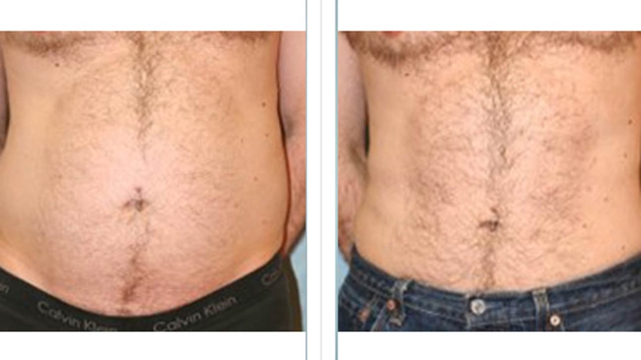 laser liposuction