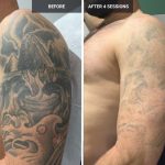 Transformations Unveiled Laser Tattoo Removal Before and After laser tattoo removal before and after