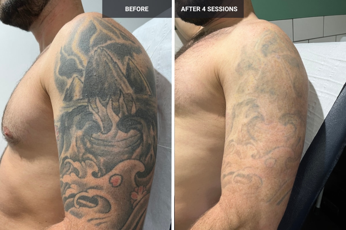 Transformations Unveiled Laser Tattoo Removal Before and After