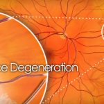 Lattice Degeneration Causes, Symptoms, and Treatment Options lattice degeneration