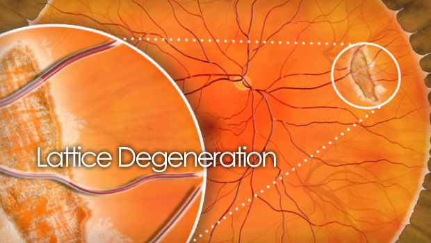 lattice degeneration