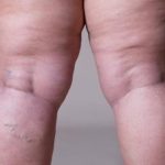 Effective Lipedema Treatment Options Managing Pain and Swelling lipedema treatment