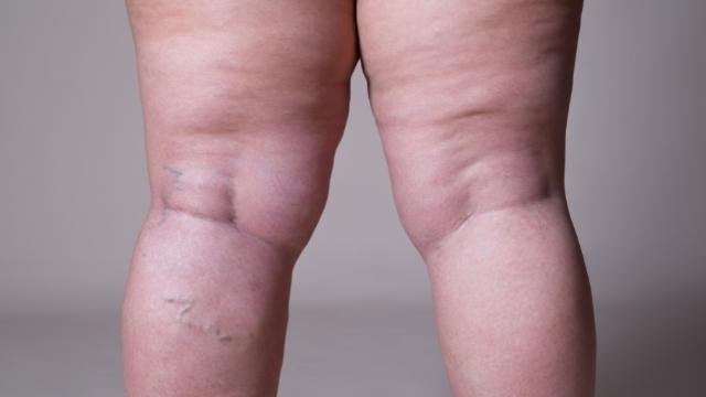 lipedema treatment