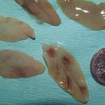 Liver Fluke Symptoms, Causes, and Prevention liver fluke