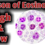 Demystifying Low Eosinophils: Causes, Symptoms, and Treatment Options low eosinophils