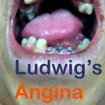 Ludwig’s Angina Causes, Symptoms, and Treatment Options ludwig's angina