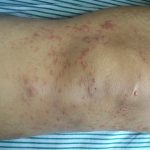 Decoding Lymphoma Rash Signs, Symptoms, and Insights lymphoma rash