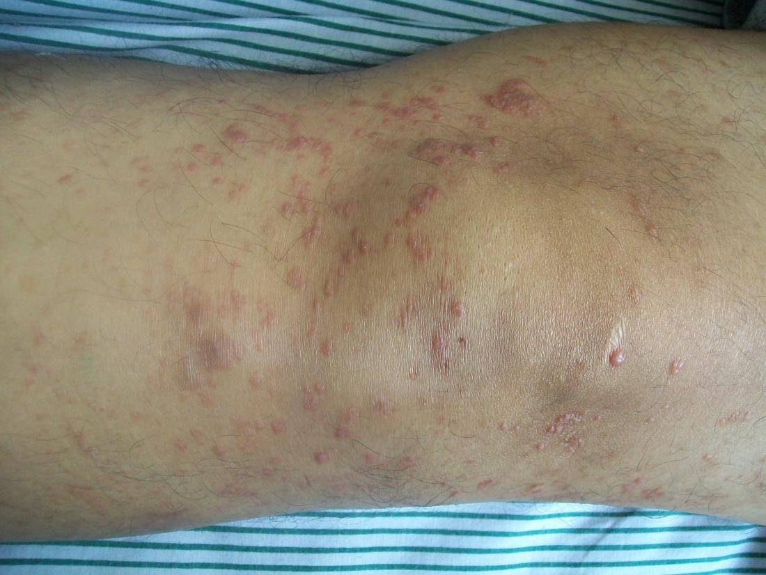 lymphoma rash