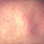 Demystifying the Maculopapular Rash Causes, Symptoms, and Treatment maculopapular rash