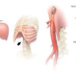 Demystifying MALS the Enigma of Median Arcuate Ligament Syndrome mals