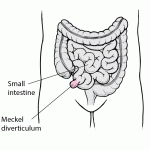 Meckel Diverticulum: An In-Depth Exploration of This Rare Gastrointestinal Anomaly meckel diverticulum