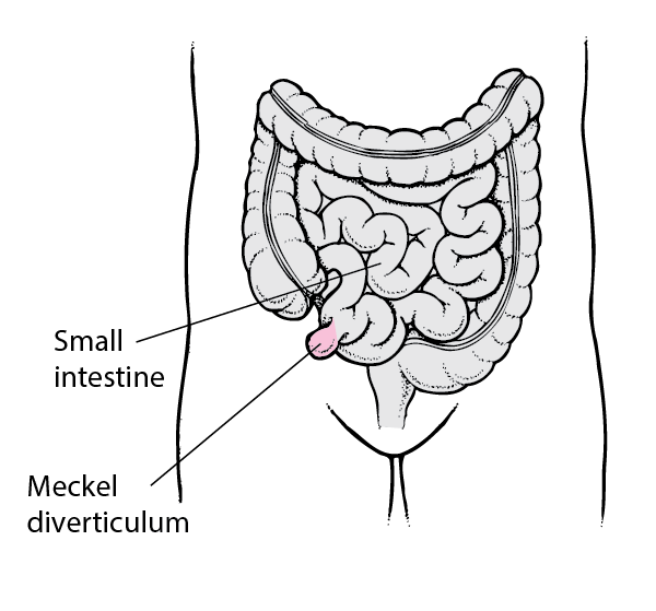 meckel diverticulum