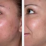 Transform Your Skin: Microdermabrasion Before and After microdermabrasion before and after