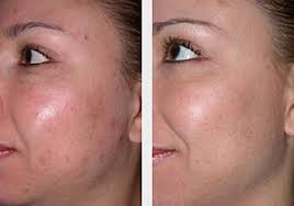 microdermabrasion before and after