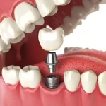 The Mighty Molars: Your Strongest Teeth Explained molars