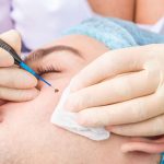 Say Goodbye to Moles The Ultimate Guide to Safe and Effective Mole Removal mole removal