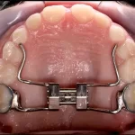 Unlocking a Better Smile: The Ultimate Guide to Mouth Expanders mouth expander