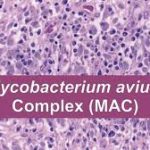 Demystifying Mycobacterium Avium Complex: Causes, Symptoms, and Treatmen mycobacterium avium complex