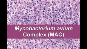 mycobacterium avium complex