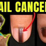 Nail Cancer: Detection, Causes, and Protection nail cancer