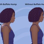 Neck Hump Causes, Prevention, and Solutions neck hump