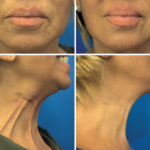 Nefertiti Lift: Age-Defying Beauty nefertiti lift