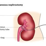 Navigating the Essentials of a Nephrostomy Tube: What You Need to Know nephrostomy tube