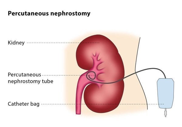 nephrostomy tube