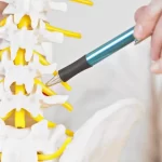 Demystifying Neural Foraminal Stenosis: Causes, Symptoms, and Treatment neural foraminal stenosis