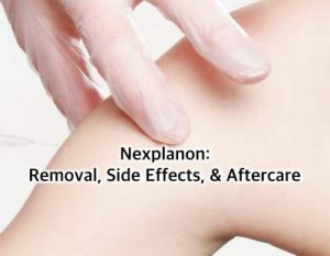 Nexplanon Removal: What You Need to Know