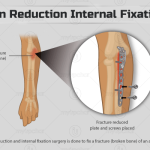 ORIF Surgery: Orthopedic Procedure Explained orif