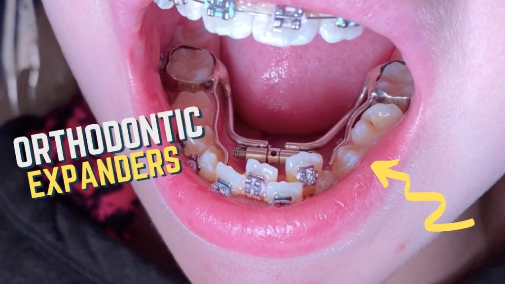 orthodontic expander