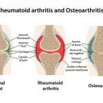 Deciphering Osteoarthritis vs Rheumatoid Arthritis: A Comprehensive Comparison