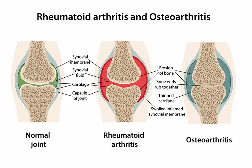 osteoarthritis vs rheumatoid arthritis