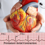 Demystifying PAC ECG: The Science Behind Premature Atrial Contractions pac ecg