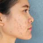 Papules Acne: Causes, Treatment, and Skincare Tips papules acne
